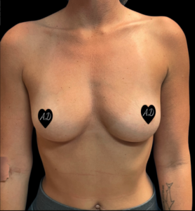 Breast Augmentation